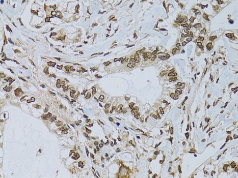 EMD / Emerin Antibody - Immunohistochemistry of paraffin-embedded human gastric cancer using EMD antibody at dilution of 1:100 (40x lens).