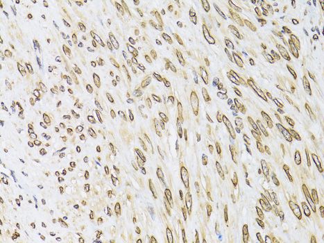 EMD / Emerin Antibody - Immunohistochemistry of paraffin-embedded human uterine cancer using EMD antibody at dilution of 1:100 (40x lens).
