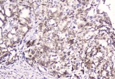 EMD / Emerin Antibody - IHC analysis of Emerin using anti-Emerin antibody. Emerin was detected in paraffin-embedded section of human gastric cancer tissue. Heat mediated antigen retrieval was performed in citrate buffer (pH6, epitope retrieval solution) for 20 mins. The tissue section was blocked with 10% goat serum. The tissue section was then incubated with 2µg/ml mouse anti-Emerin Antibody overnight at 4°C. Biotinylated goat anti-mouse IgG was used as secondary antibody and incubated for 30 minutes at 37°C. The tissue section was developed using Strepavidin-Biotin-Complex (SABC) with DAB as the chromogen.