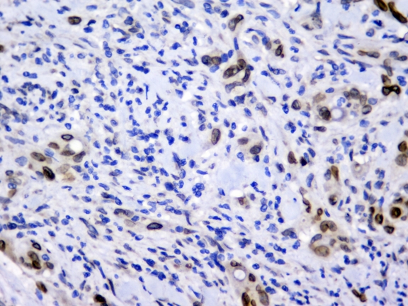 EMD / Emerin Antibody - IHC analysis of Emerin using anti-Emerin antibody. Emerin was detected in paraffin-embedded section of human rectal cancer tissue. Heat mediated antigen retrieval was performed in citrate buffer (pH6, epitope retrieval solution) for 20 mins. The tissue section was blocked with 10% goat serum. The tissue section was then incubated with 2µg/ml mouse anti-Emerin Antibody overnight at 4°C. Biotinylated goat anti-mouse IgG was used as secondary antibody and incubated for 30 minutes at 37°C. The tissue section was developed using Strepavidin-Biotin-Complex (SABC) with DAB as the chromogen.