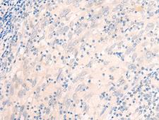 EME2 Antibody - Immunohistochemistry of paraffin-embedded Human cervical cancer tissue  using EME2 Polyclonal Antibody at dilution of 1:40(×200)