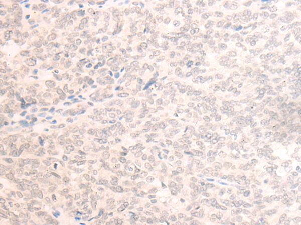 EME2 Antibody - Immunohistochemistry of paraffin-embedded Human ovarian cancer tissue  using EME2 Polyclonal Antibody at dilution of 1:40(×200)