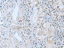 EMILIN1 / EMI Antibody - Immunohistochemistry of paraffin-embedded Human liver cancer tissue  using EMILIN1 Polyclonal Antibody at dilution of 1:55(×200)