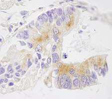 EML4 Antibody - Detection of Human EML4 by Immunohistochemistry. Sample: FFPE section of human lung adenocarcinoma. Antibody: Affinity purified rabbit anti-EML4 used at a dilution of 1:250.
