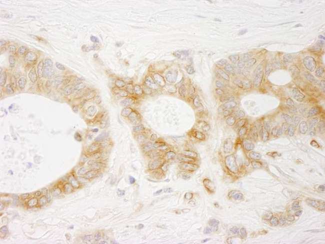 EML4 Antibody - Detection of Human EML4 by Immunohistochemistry. Sample: FFPE section of human ovarian carcinoma. Antibody: Affinity purified rabbit anti-EML4 used at a dilution of 1:250.