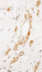 EML4 Antibody - Detection of Human EML4 by Immunohistochemistry. Sample: FFPE section of human Lin Plastica stomach cancer. Antibody: Affinity purified rabbit anti-EML4 used at a dilution of1:200 (1Detection: DAB.