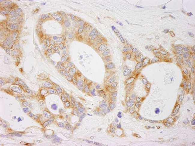 EML4 Antibody - Detection of Human EML4 by Immunohistochemistry. Sample: FFPE section of human ovarian carcinoma. Antibody: Affinity purified rabbit anti-EML4 used at a dilution of1:1000 (1Detection: DAB.