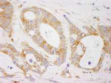EML4 Antibody - Detection of Human EML4 by Immunohistochemistry. Sample: FFPE section of human ovarian carcinoma. Antibody: Affinity purified rabbit anti-EML4 used at a dilution of1:1000 (1Detection: DAB.