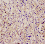 EML4 Antibody - IHC analysis of EML4 using anti-EML4 antibody. EML4 was detected in paraffin-embedded section of human appendicitis tissue. Heat mediated antigen retrieval was performed in citrate buffer (pH6, epitope retrieval solution) for 20 mins. The tissue section was blocked with 10% goat serum. The tissue section was then incubated with 1µg/ml rabbit anti-EML4 Antibody overnight at 4°C. Biotinylated goat anti-rabbit IgG was used as secondary antibody and incubated for 30 minutes at 37°C. The tissue section was developed using Strepavidin-Biotin-Complex (SABC) with DAB as the chromogen.