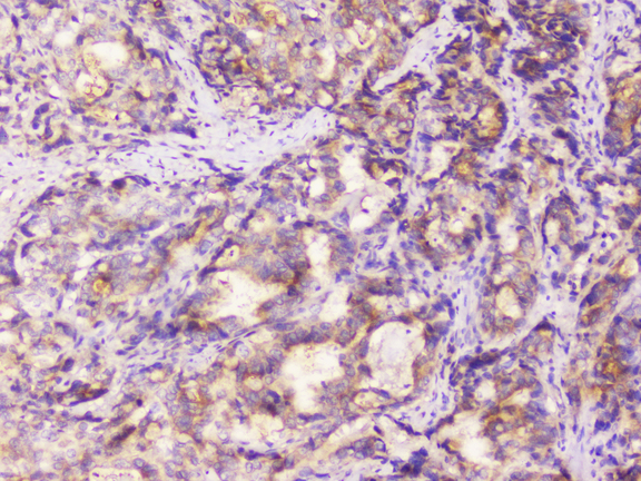 EML4 Antibody - IHC analysis of EML4 using anti-EML4 antibody. EML4 was detected in paraffin-embedded section of human gastric cancer tissue. Heat mediated antigen retrieval was performed in citrate buffer (pH6, epitope retrieval solution) for 20 mins. The tissue section was blocked with 10% goat serum. The tissue section was then incubated with 1µg/ml rabbit anti-EML4 Antibody overnight at 4°C. Biotinylated goat anti-rabbit IgG was used as secondary antibody and incubated for 30 minutes at 37°C. The tissue section was developed using Strepavidin-Biotin-Complex (SABC) with DAB as the chromogen.