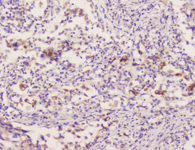 EML4 Antibody - IHC analysis of EML4 using anti-EML4 antibody. EML4 was detected in paraffin-embedded section of human lung cancer tissue. Heat mediated antigen retrieval was performed in citrate buffer (pH6, epitope retrieval solution) for 20 mins. The tissue section was blocked with 10% goat serum. The tissue section was then incubated with 1µg/ml rabbit anti-EML4 Antibody overnight at 4°C. Biotinylated goat anti-rabbit IgG was used as secondary antibody and incubated for 30 minutes at 37°C. The tissue section was developed using Strepavidin-Biotin-Complex (SABC) with DAB as the chromogen.