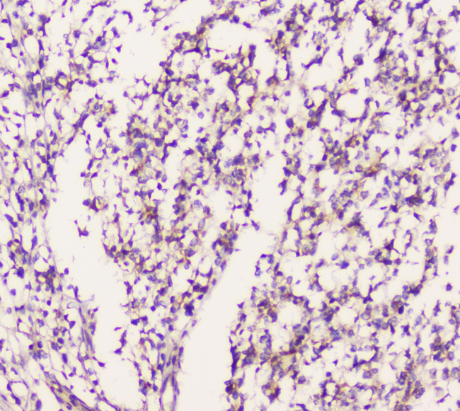 EML4 Antibody - IHC analysis of EML4 using anti-EML4 antibody. EML4 was detected in paraffin-embedded section of human glioma tissue. Heat mediated antigen retrieval was performed in citrate buffer (pH6, epitope retrieval solution) for 20 mins. The tissue section was blocked with 10% goat serum. The tissue section was then incubated with 1µg/ml rabbit anti-EML4 Antibody overnight at 4°C. Biotinylated goat anti-rabbit IgG was used as secondary antibody and incubated for 30 minutes at 37°C. The tissue section was developed using Strepavidin-Biotin-Complex (SABC) with DAB as the chromogen.