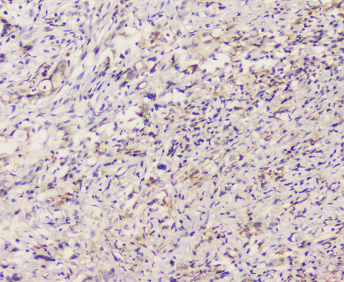 EML4 Antibody - IHC analysis of EML4 using anti-EML4 antibody. EML4 was detected in paraffin-embedded section of human rectal cancer tissue. Heat mediated antigen retrieval was performed in citrate buffer (pH6, epitope retrieval solution) for 20 mins. The tissue section was blocked with 10% goat serum. The tissue section was then incubated with 1µg/ml rabbit anti-EML4 Antibody overnight at 4°C. Biotinylated goat anti-rabbit IgG was used as secondary antibody and incubated for 30 minutes at 37°C. The tissue section was developed using Strepavidin-Biotin-Complex (SABC) with DAB as the chromogen.