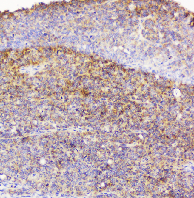 EML4 Antibody - IHC analysis of EML4 using anti-EML4 antibody. EML4 was detected in paraffin-embedded section of human sarcoma tissue. Heat mediated antigen retrieval was performed in citrate buffer (pH6, epitope retrieval solution) for 20 mins. The tissue section was blocked with 10% goat serum. The tissue section was then incubated with 1µg/ml rabbit anti-EML4 Antibody overnight at 4°C. Biotinylated goat anti-rabbit IgG was used as secondary antibody and incubated for 30 minutes at 37°C. The tissue section was developed using Strepavidin-Biotin-Complex (SABC) with DAB as the chromogen.