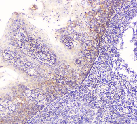 EML4 Antibody - IHC analysis of EML4 using anti-EML4 antibody. EML4 was detected in paraffin-embedded section of human tonsil tissue. Heat mediated antigen retrieval was performed in citrate buffer (pH6, epitope retrieval solution) for 20 mins. The tissue section was blocked with 10% goat serum. The tissue section was then incubated with 1µg/ml rabbit anti-EML4 Antibody overnight at 4°C. Biotinylated goat anti-rabbit IgG was used as secondary antibody and incubated for 30 minutes at 37°C. The tissue section was developed using Strepavidin-Biotin-Complex (SABC) with DAB as the chromogen.