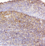 EML4 Antibody - IHC staining of FFPE human sarcoma with EML4 antibody at 1ug/ml. HIER: boil tissue sections in pH6, 10mM citrate buffer, for 10-20 min followed by cooling at RT for 20 min.