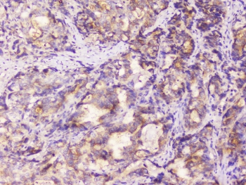 EML4 Antibody - IHC staining of FFPE human stomach cancer with EML4 antibody at 1ug/ml. HIER: boil tissue sections in pH6, 10mM citrate buffer, for 10-20 min followed by cooling at RT for 20 min.