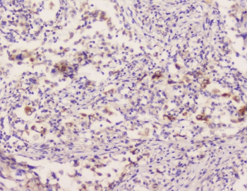 EML4 Antibody - IHC staining of FFPE human lung cancer with EML4 antibody at 1ug/ml. HIER: boil tissue sections in pH6, 10mM citrate buffer, for 10-20 min followed by cooling at RT for 20 min.