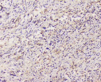 EML4 Antibody - IHC staining of FFPE human rectal cancer with EML4 antibody at 1ug/ml. HIER: boil tissue sections in pH6, 10mM citrate buffer, for 10-20 min followed by cooling at RT for 20 min.
