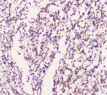 EML4 Antibody - IHC staining of FFPE human glioma with EML4 antibody at 1ug/ml. HIER: boil tissue sections in pH6, 10mM citrate buffer, for 10-20 min followed by cooling at RT for 20 min.