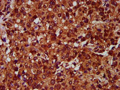 EMP2 Antibody - Immunohistochemistry Dilution at 1:400 and staining in paraffin-embedded human glioma cancer performed on a Leica BondTM system. After dewaxing and hydration, antigen retrieval was mediated by high pressure in a citrate buffer (pH 6.0). Section was blocked with 10% normal Goat serum 30min at RT. Then primary antibody (1% BSA) was incubated at 4°C overnight. The primary is detected by a biotinylated Secondary antibody and visualized using an HRP conjugated SP system.