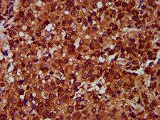 EMP2 Antibody - Immunohistochemistry Dilution at 1:400 and staining in paraffin-embedded human glioma cancer performed on a Leica BondTM system. After dewaxing and hydration, antigen retrieval was mediated by high pressure in a citrate buffer (pH 6.0). Section was blocked with 10% normal Goat serum 30min at RT. Then primary antibody (1% BSA) was incubated at 4°C overnight. The primary is detected by a biotinylated Secondary antibody and visualized using an HRP conjugated SP system.