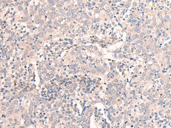 EMX1 Antibody - Immunohistochemistry of paraffin-embedded Human cervical cancer tissue  using EMX1 Polyclonal Antibody at dilution of 1:25(×200)