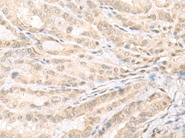 EMX1 Antibody - Immunohistochemistry of paraffin-embedded Human thyroid cancer tissue  using EMX1 Polyclonal Antibody at dilution of 1:25(×200)