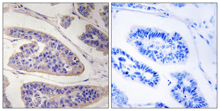 ENAH / MENA Antibody - Immunohistochemistry analysis of paraffin-embedded human breast carcinoma tissue, using ENAH Antibody. The picture on the right is blocked with the synthesized peptide.