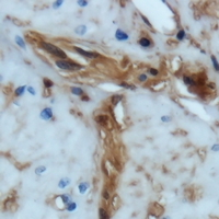 ENAH / MENA Antibody - Immunohistochemical analysis of MENA staining in human prostate cancer formalin fixed paraffin embedded tissue section. The section was pre-treated using heat mediated antigen retrieval with sodium citrate buffer (pH 6.0). The section was then incubated with the antibody at room temperature and detected using an HRP polymer system. DAB was used as the chromogen. The section was then counterstained with hematoxylin and mounted with DPX.