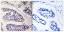 ENAH / MENA Antibody - Peptide - + Immunohistochemistry analysis of paraffin-embedded human breast carcinoma tissue, using ENAH antibody.