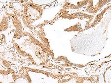 ENAH / MENA Antibody - Immunohistochemistry of paraffin-embedded Human thyroid cancer tissue  using ENAH Polyclonal Antibody at dilution of 1:60(×200)