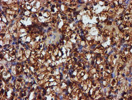 Endonuclease G / ENDOG Antibody - IHC of paraffin-embedded Carcinoma of Human kidney tissue using anti-ENDOG mouse monoclonal antibody. (Heat-induced epitope retrieval by 10mM citric buffer, pH6.0, 100C for 10min).