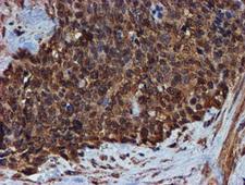 Endonuclease G / ENDOG Antibody - IHC of paraffin-embedded Adenocarcinoma of Human breast tissue using anti-ENDOG mouse monoclonal antibody. (Heat-induced epitope retrieval by 10mM citric buffer, pH6.0, 100C for 10min).