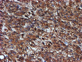 Endonuclease G / ENDOG Antibody - IHC of paraffin-embedded Carcinoma of Human liver tissue using anti-ENDOG mouse monoclonal antibody. (Heat-induced epitope retrieval by 10mM citric buffer, pH6.0, 100C for 10min).