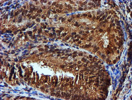 Endonuclease G / ENDOG Antibody - IHC of paraffin-embedded Adenocarcinoma of Human endometrium tissue using anti-ENDOG mouse monoclonal antibody. (Heat-induced epitope retrieval by 10mM citric buffer, pH6.0, 100C for 10min).