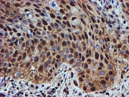 Endonuclease G / ENDOG Antibody - IHC of paraffin-embedded Carcinoma of Human bladder tissue using anti-ENDOG mouse monoclonal antibody. (Heat-induced epitope retrieval by 10mM citric buffer, pH6.0, 100C for 10min).