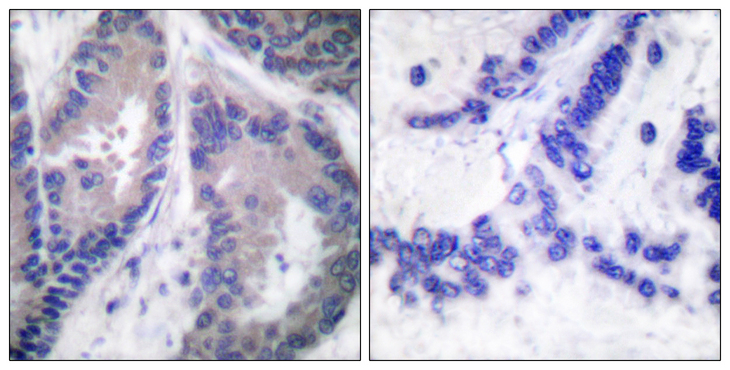 Endostatin Antibody - Immunohistochemistry analysis of paraffin-embedded human lung carcinoma tissue, using Collagen alpha1 XVIII Antibody. The picture on the right is blocked with the synthesized peptide.