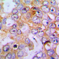 Endostatin Antibody - Immunohistochemical analysis of Collagen 18 alpha 1 staining in human lung cancer formalin fixed paraffin embedded tissue section. The section was pre-treated using heat mediated antigen retrieval with sodium citrate buffer (pH 6.0). The section was then incubated with the antibody at room temperature and detected using an HRP conjugated compact polymer system. DAB was used as the chromogen. The section was then counterstained with hematoxylin and mounted with DPX.