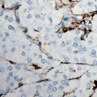 Endostatin Antibody - Immunohistochemical analysis of Collagen 18 alpha 1 staining in human breast cancer formalin fixed paraffin embedded tissue section. The section was pre-treated using heat mediated antigen retrieval with sodium citrate buffer (pH 6.0). The section was then incubated with the antibody at room temperature and detected using an HRP conjugated compact polymer system. DAB was used as the chromogen. The section was then counterstained with hematoxylin and mounted with DPX.