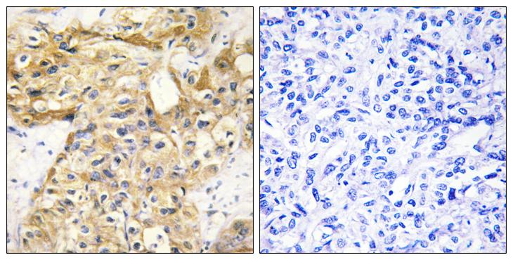Endostatin Antibody - Peptide - + Immunohistochemistry analysis of paraffin-embedded human liver carcinoma tissue using Collagen XVIII a1 antibody.