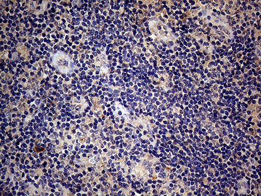 Endothelin 3 / EDN3 Antibody - Immunohistochemical staining of paraffin-embedded Carcinoma of Human lung tissue using anti-EDN3 mouse monoclonal antibody. (Heat-induced epitope retrieval by 1mM EDTA in 10mM Tris buffer. (pH8.5) at 120°C for 3 min. (1:150)