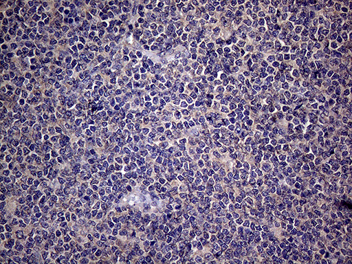 Endothelin 3 / EDN3 Antibody - Immunohistochemical staining of paraffin-embedded Human lymphoma tissue using anti-EDN3 mouse monoclonal antibody. (Heat-induced epitope retrieval by 1mM EDTA in 10mM Tris buffer. (pH8.5) at 120°C for 3 min. (1:150)