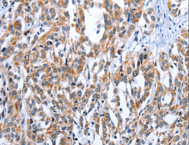 Endothelin 3 / EDN3 Antibody - Immunohistochemistry of paraffin-embedded Human thyroid cancer using EDN3 Polyclonal Antibody at dilution of 1:30.