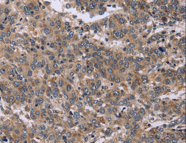 Endothelin 3 / EDN3 Antibody - Immunohistochemistry of paraffin-embedded Human liver cancer using EDN3 Polyclonal Antibody at dilution of 1:50.