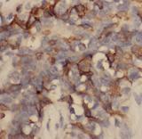 ENDOU Antibody - Immunohistochemistry of paraffin-embedded human breast cancer using P11 antibody at dilution of 1:100