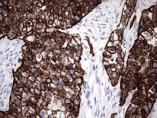 ENKUR Antibody - IHC of paraffin-embedded Carcinoma of Human kidney tissue using anti-ENKUR mouse monoclonal antibody. (Heat-induced epitope retrieval by 1 mM EDTA in 10mM Tris, pH8.5, 120°C for 3min).
