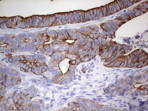 ENKUR Antibody - IHC of paraffin-embedded Adenocarcinoma of Human colon tissue using anti-ENKUR mouse monoclonal antibody. (Heat-induced epitope retrieval by 1 mM EDTA in 10mM Tris, pH8.5, 120°C for 3min).