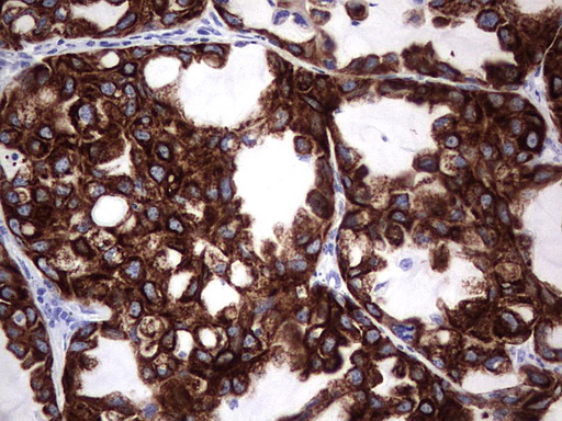 ENKUR Antibody - IHC of paraffin-embedded Carcinoma of Human lung tissue using anti-ENKUR mouse monoclonal antibody. (Heat-induced epitope retrieval by 1 mM EDTA in 10mM Tris, pH8.5, 120°C for 3min).