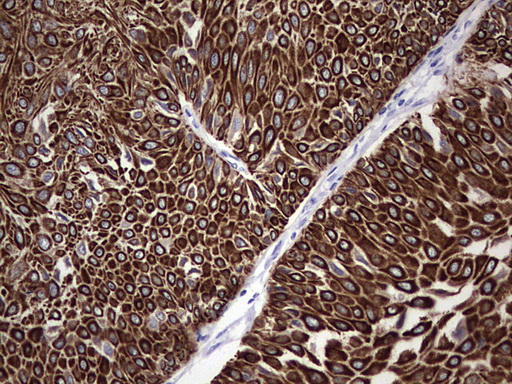 ENKUR Antibody - IHC of paraffin-embedded Carcinoma of Human bladder tissue using anti-ENKUR mouse monoclonal antibody. (Heat-induced epitope retrieval by 1 mM EDTA in 10mM Tris, pH8.5, 120°C for 3min).